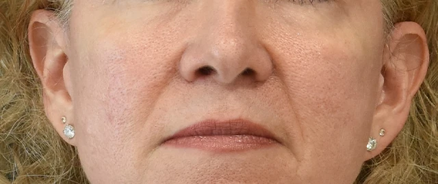 Eyelid Surgery Patient 28 Set 1 After