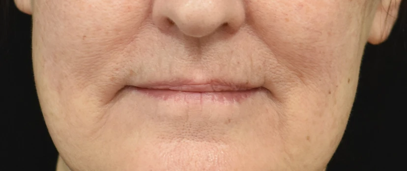 Lip Lift Patient 15 Set 1 Before